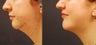 Chin implant and liposuction