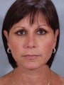 Revision Rhinoplasty 