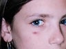 15 year old female patient 