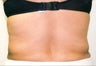 Liposuction