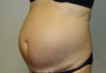 Tummy tuck