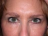 Botox
