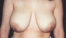 Breast reduction