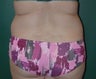 Liposuction