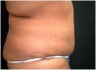 Tummy tuck