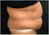 Tummy tuck