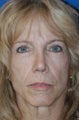 Revision Rhinoplasty