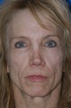 Revision Rhinoplasty