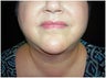 Chin liposuction
