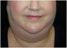 Chin liposuction