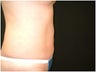 Liposuction