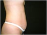 Liposuction