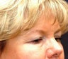 Eyelid Surgery