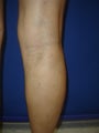 55 year old man with varicose veins