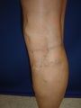 55 year old man with varicose veins
