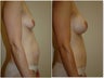 Tummy Tuck
