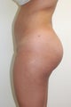 Buttock Enhancement