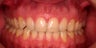 Invisalign