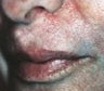 Skin tightening