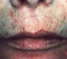 Skin tightening