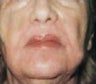 Skin tightening