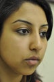 Rhinoplasty