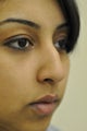 Rhinoplasty