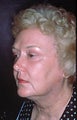 Full face laser skin resurfacing with upper and lower blepharoplasty 