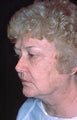 Full face laser skin resurfacing with upper and lower blepharoplasty 
