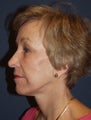 Facelift