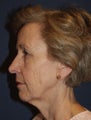 Facelift