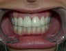 Porcelain Veneers