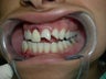 Porcelain Veneers