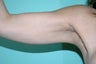 Arm Lift