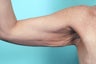 Arm Lift