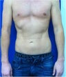 Laser Liposuction