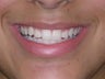 Teenager Treated with Lingual Braces and Porcelain Veneers