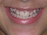 Teenager Treated with Lingual Braces and Porcelain Veneers