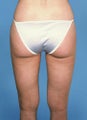Liposculpture 