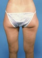 Liposculpture 