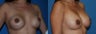 Revision Breast Surgery / Breast Implant Revision 