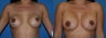 Revision Breast Surgery / Breast Implant Revision 