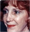Eyelid Surgery