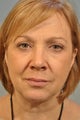 Lower lid Hetter Peel along with upper and lower eyelid surgery. 