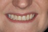 Porcelain veneers
