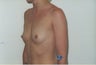 Breast Implants