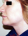 Neck Lift 