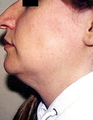 Neck Lift 