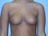 Breast Augmentation