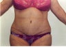 Tummy tuck